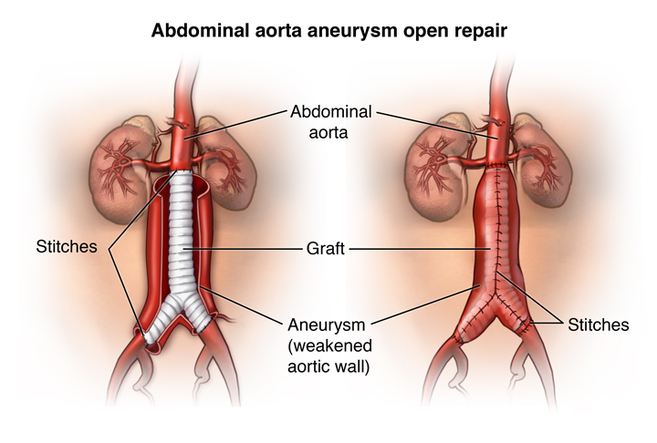 Anterior view of the surgical steps of an open abdominal aortic aneurysm (AAA) repair, with suturing of aortic graft;  
SOURCE: cardiacsurg_aaa-open_proc_2.ai; 3D_normal_cns.mb, outline: cardiology_cardio-stent-place_procedure_1_line.ai; cardiology_heart_slide_template; cardiacsurg_aaa-open_proc_2a_layers.psd; cardiacsurg_aaa-open_proc_2b_layers.psd;