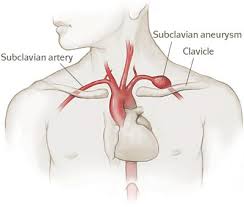 aneurizma-potkljucne-arterije