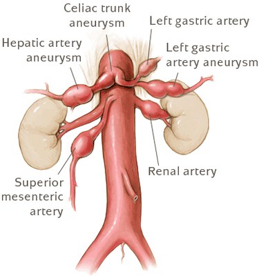 aneurizme-visceralnih-grana-trbusne-aorte