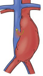 aortno-entericna-fistule