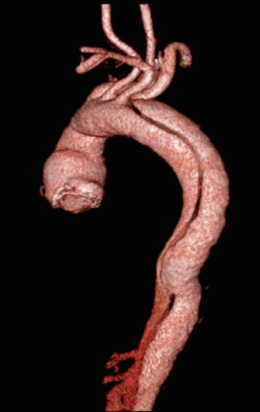 disekcija-aorte