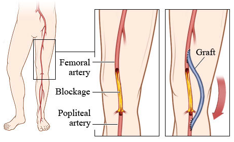 femoral-bypass-graphic