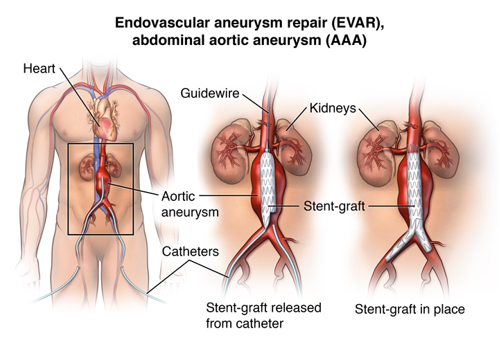 Anterior view of male figure with double femoral artery catheter insertion for endovascular AAA repair (EVAR). Shows stent graft placement;
PCardio_20140902_v0_001; 

SOURCE: cardiacsurg_aaa-endo_proc_1.ai ; cardiacsurg_aaa-endo_proc_2.ai; 3D_normal_cns.mb, outline: cardiology_cardio-stent-place_procedure_1_line.ai; cardiology_heart_slide_template; cardiacsurg_aaa-endo_proc_1_layers.psd; 3D_Normal_Kidneys.mb